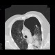 Bullous emphysema, pneumothorax: CT - Computed tomography